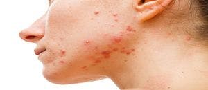 Minocycline Approved by FDA for Treatment of Moderate to Severe Acne Vulgaris