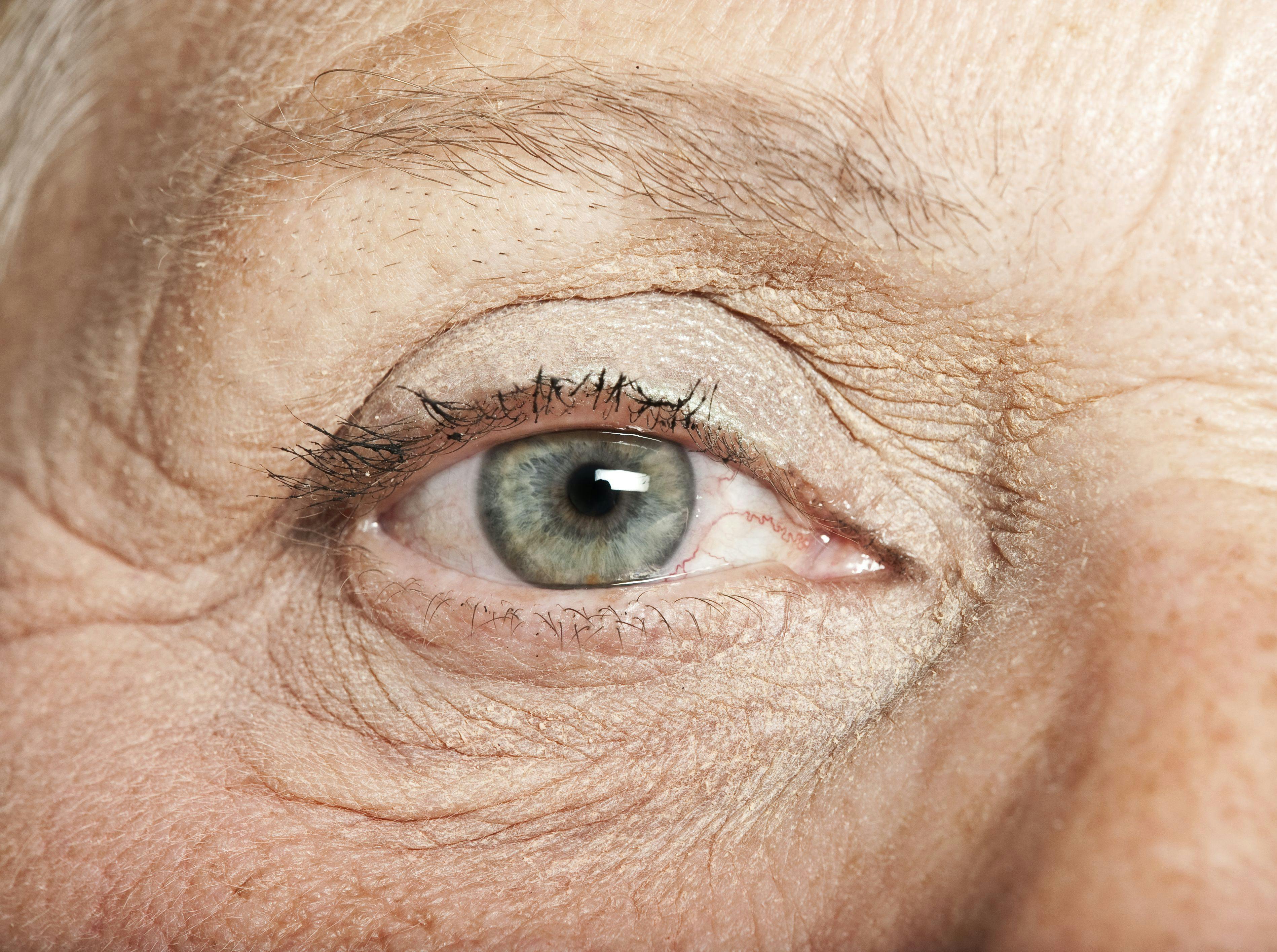 Study: Sight Conditions in Older Adults Associated with Increased Risk of Dementia