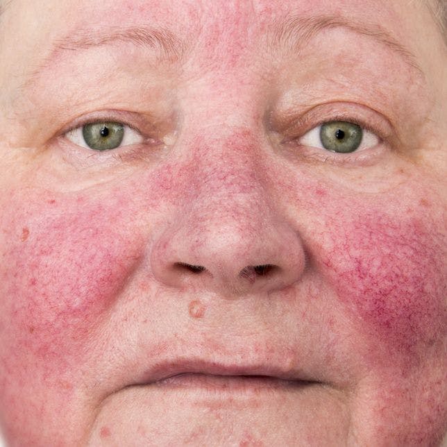Rosacea Awareness Month Highlights a Patient's Need for the Right Treatment