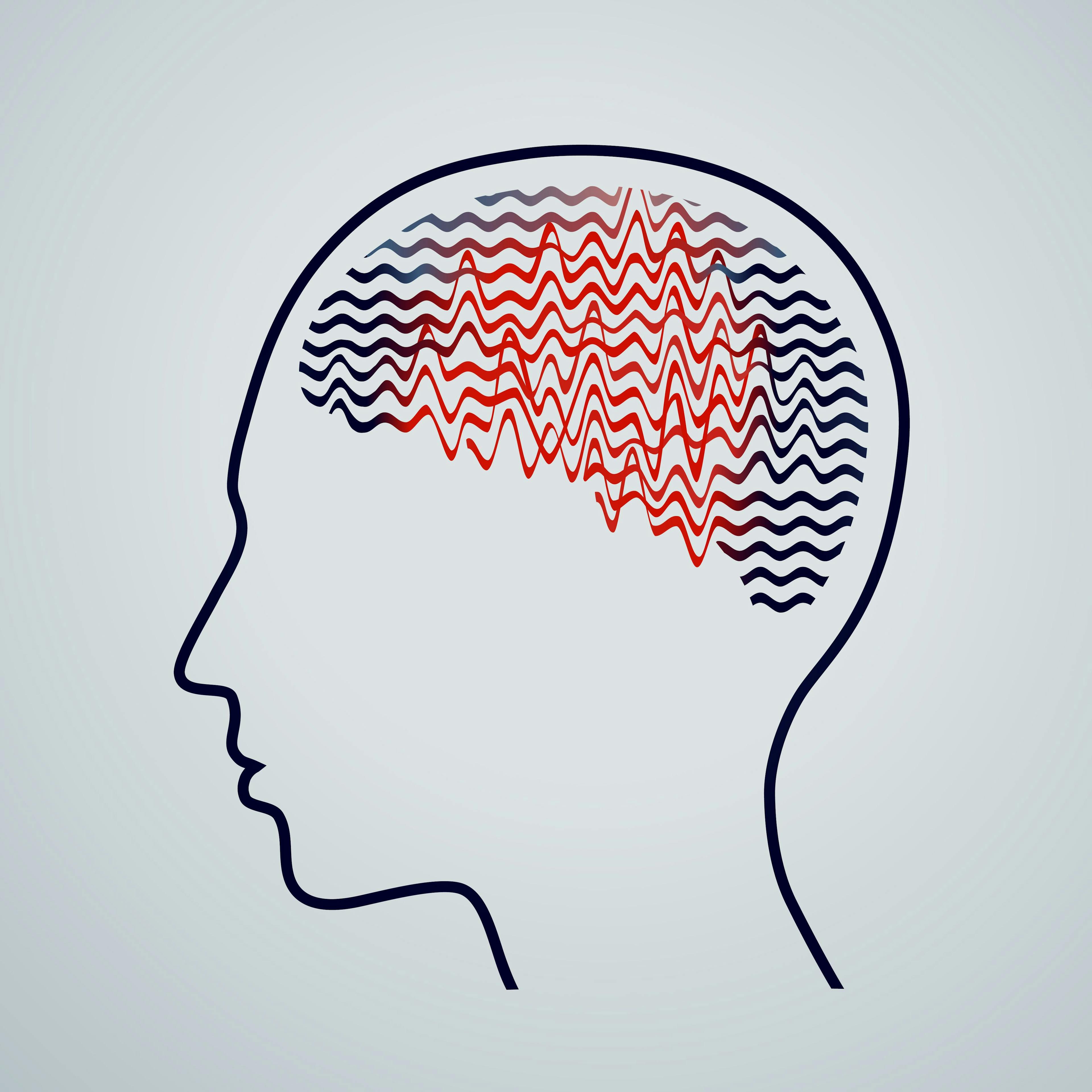Expert: 80% of Patients With Functional Seizures Are Initially Misdiagnosed With Epilepsy