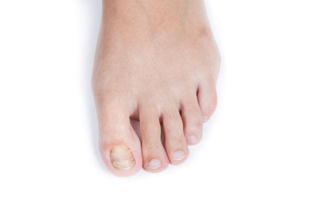 FDA Approved Efinaconazole for Children with Toenail Fungal Infection