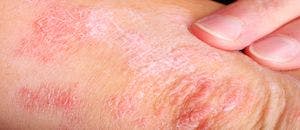 FDA Approves Guselkumab Self-Injector for Adults With Plaque Psoriasis