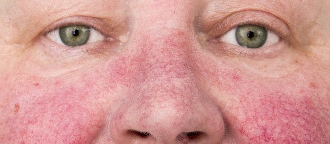 10 Steps to Counseling Patients With Rosacea